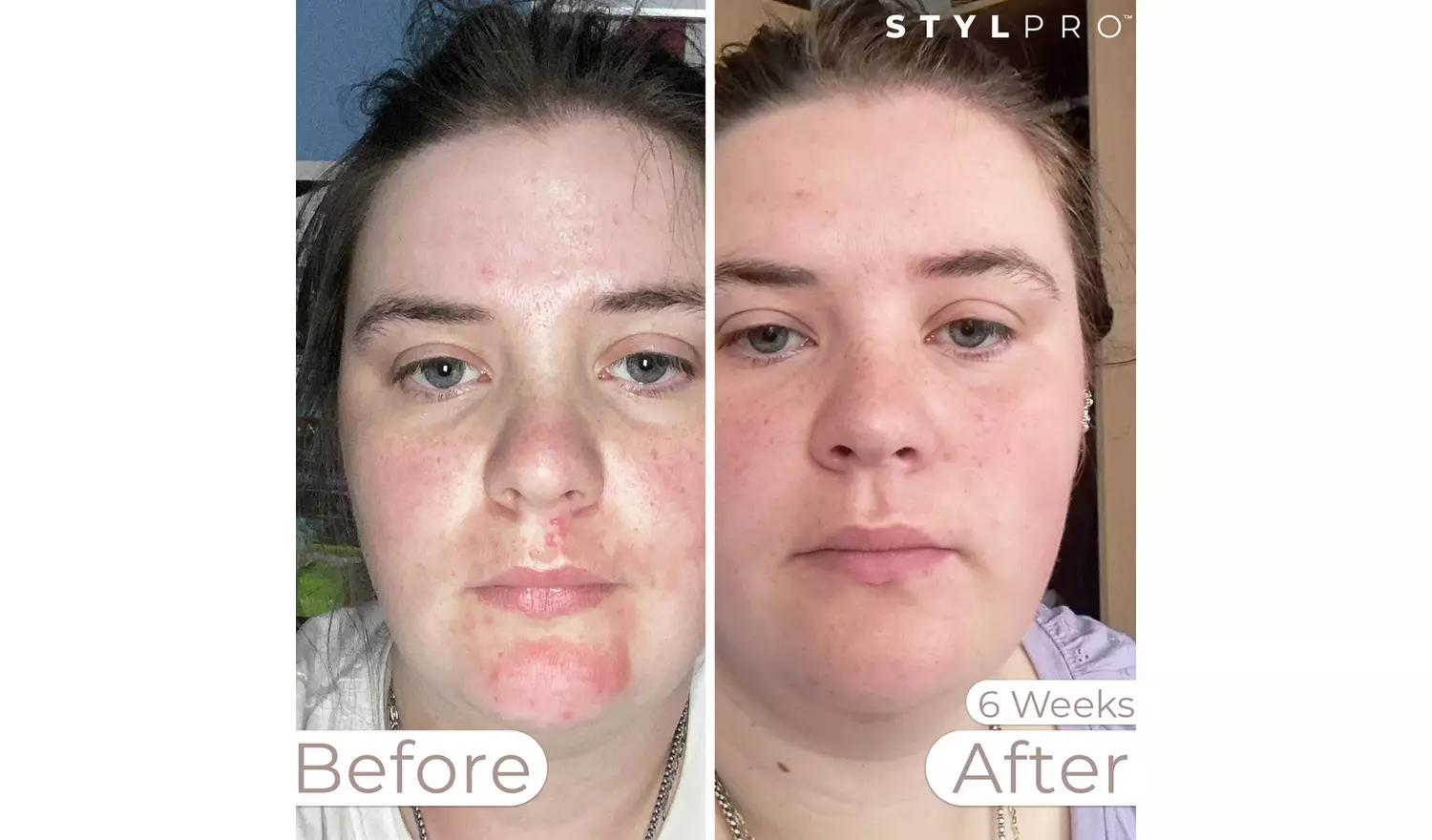 Stylpro Weavelength LED Face Mask