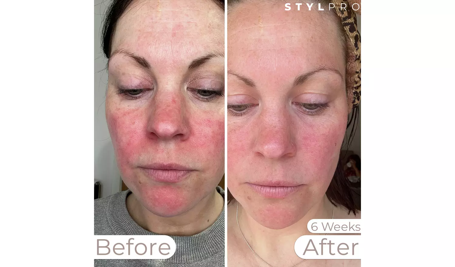 Stylpro Weavelength LED Face Mask