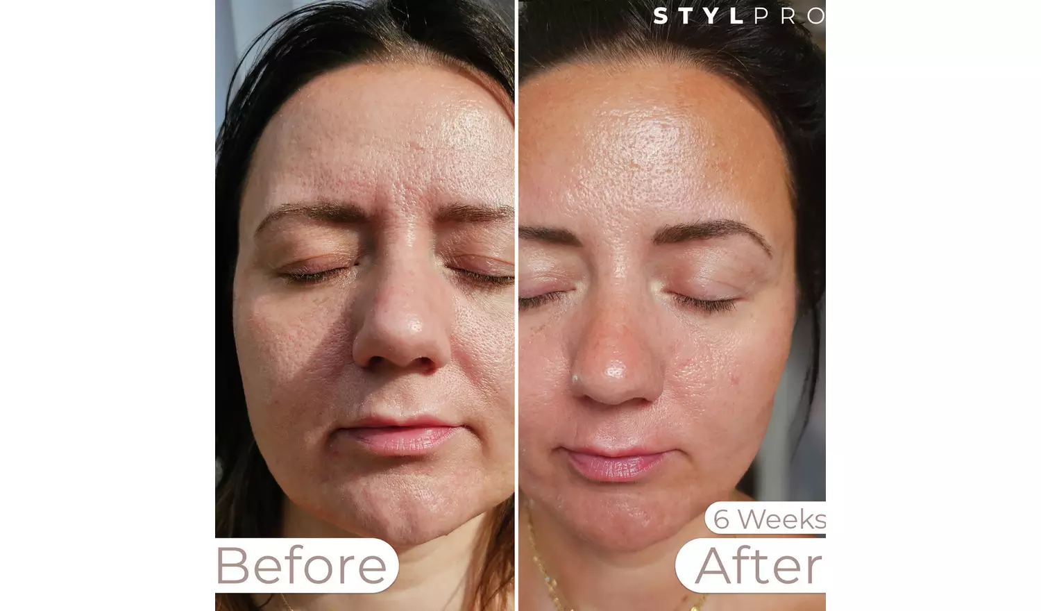 Stylpro Weavelength LED Face Mask