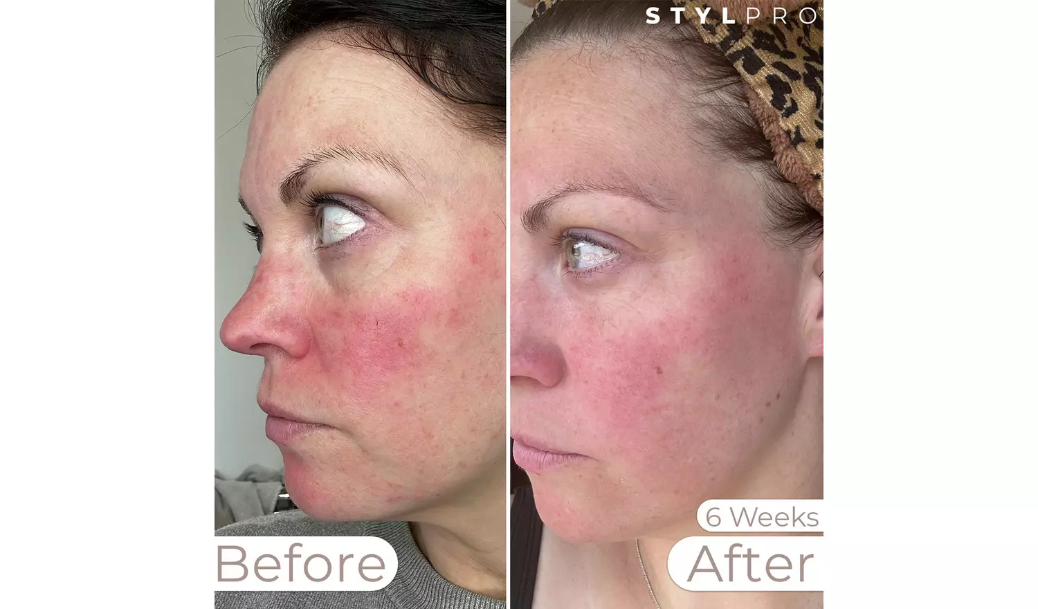 Stylpro Weavelength LED Face Mask