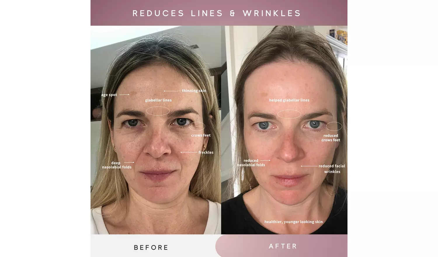 Sensse Professional LED Light Therapy Facial Mask