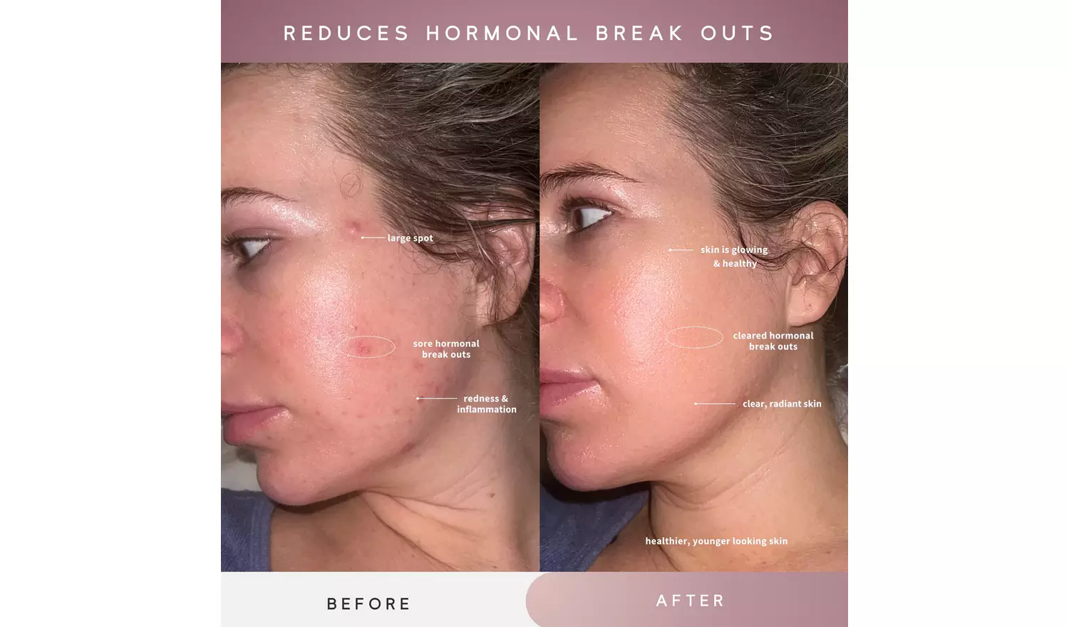 Sensse Professional LED Light Therapy Facial Mask